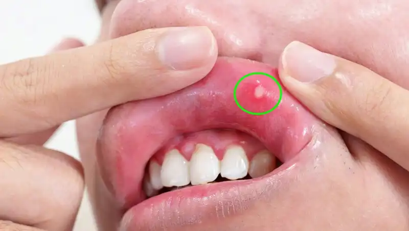 B Vitaminleri Eksikliği Belirtileri: 5 Kritik İşaret ve Önemi